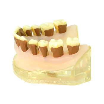 Стоматологическое заболевание пародонта Модель зубов Обучающая учебная модель Демонстрационная модель пародонтита